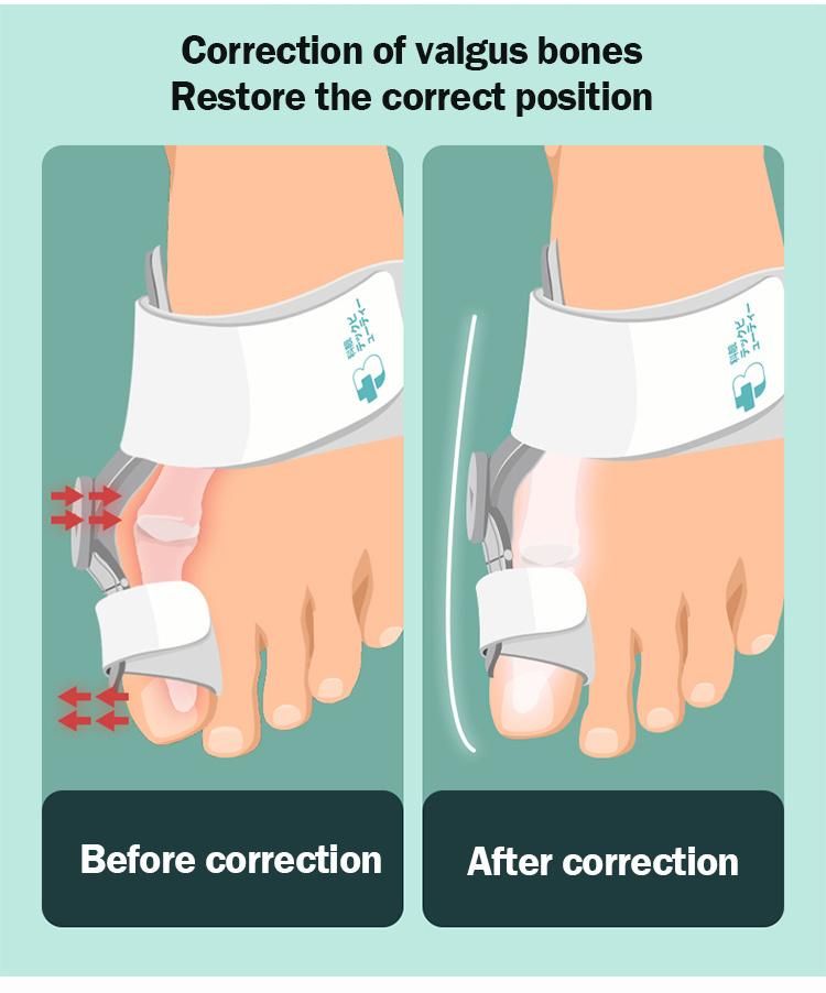 Tech Love Toe Correction Feet Care Corrector Thumb Big Bone Orthotics