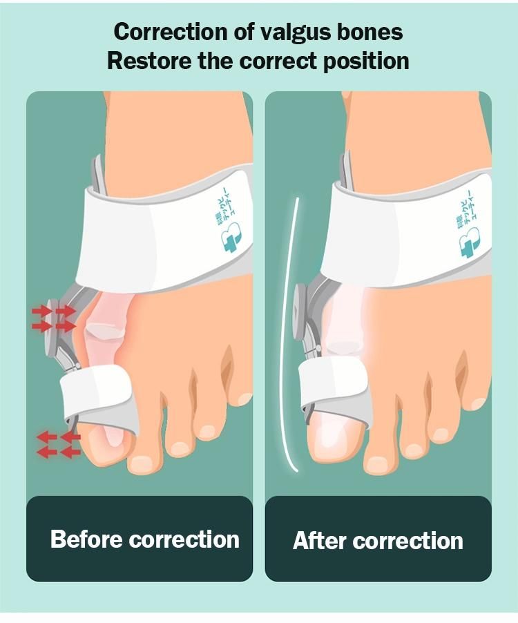 OEM Custom Bunion Corrector Hallux Valgus Orthopedic Braces Toe Correction of Night Valgus Corrector