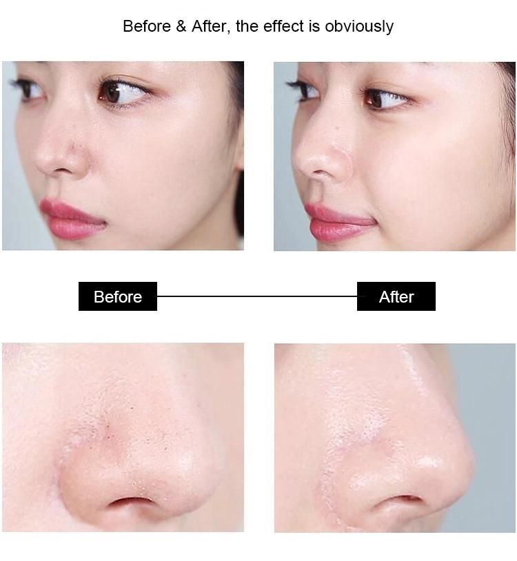 Cleanser Home Use Facial Cleaning Skin Care Dead Skin Pores Acne Comedo Cleaner